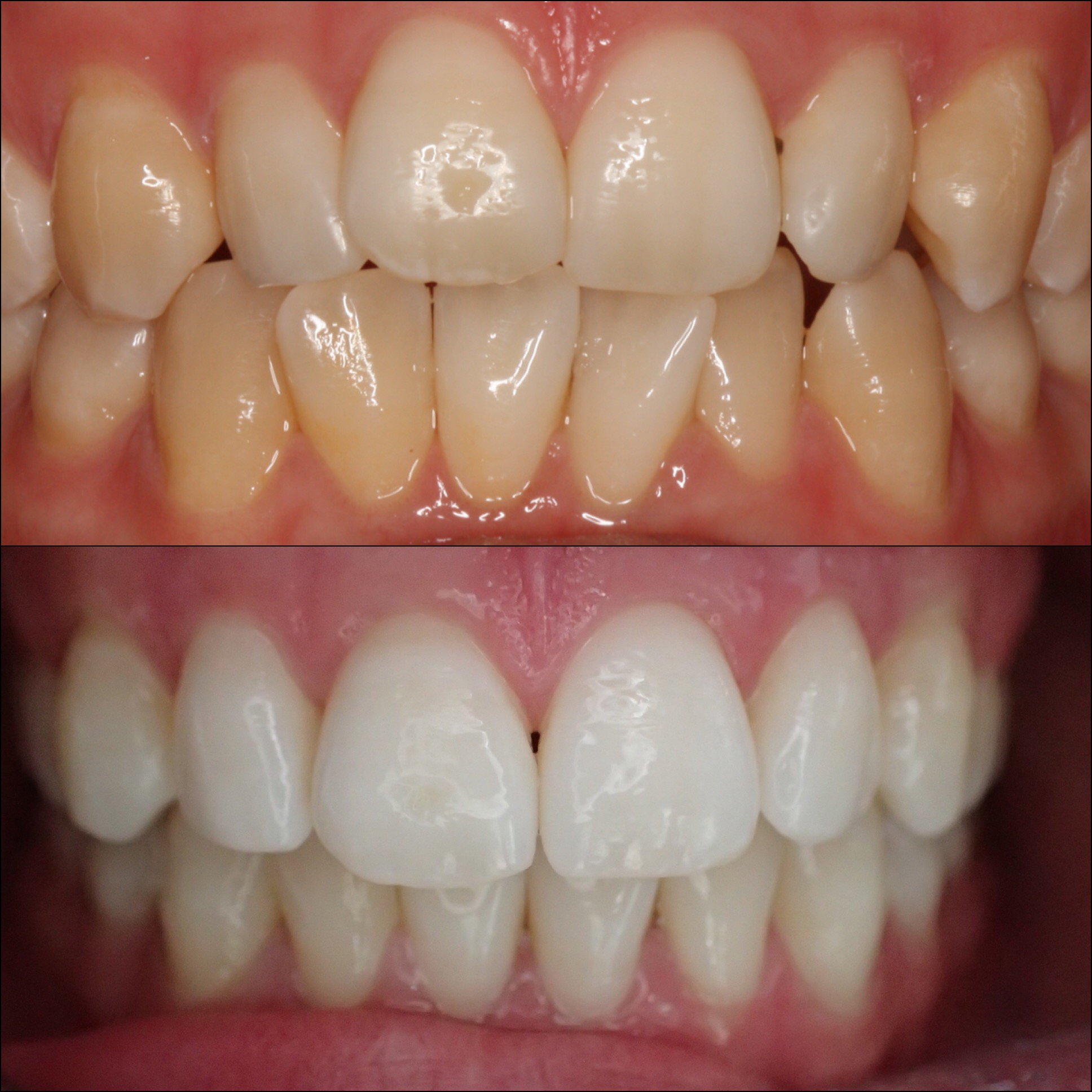 Teeth Straightening Axminster